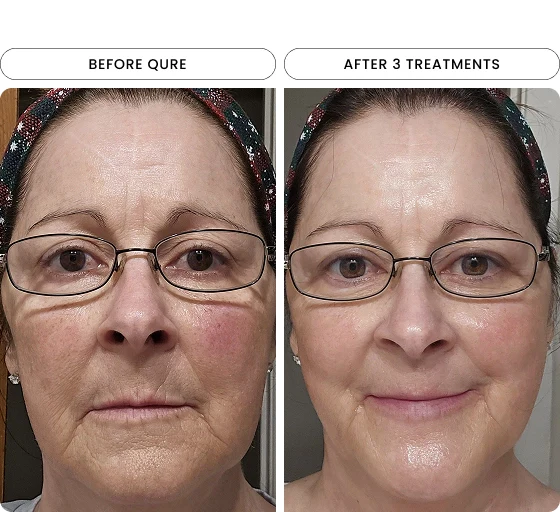 Micro-Infusion 3 Month Bundle (For Wrinkles) - Image 3