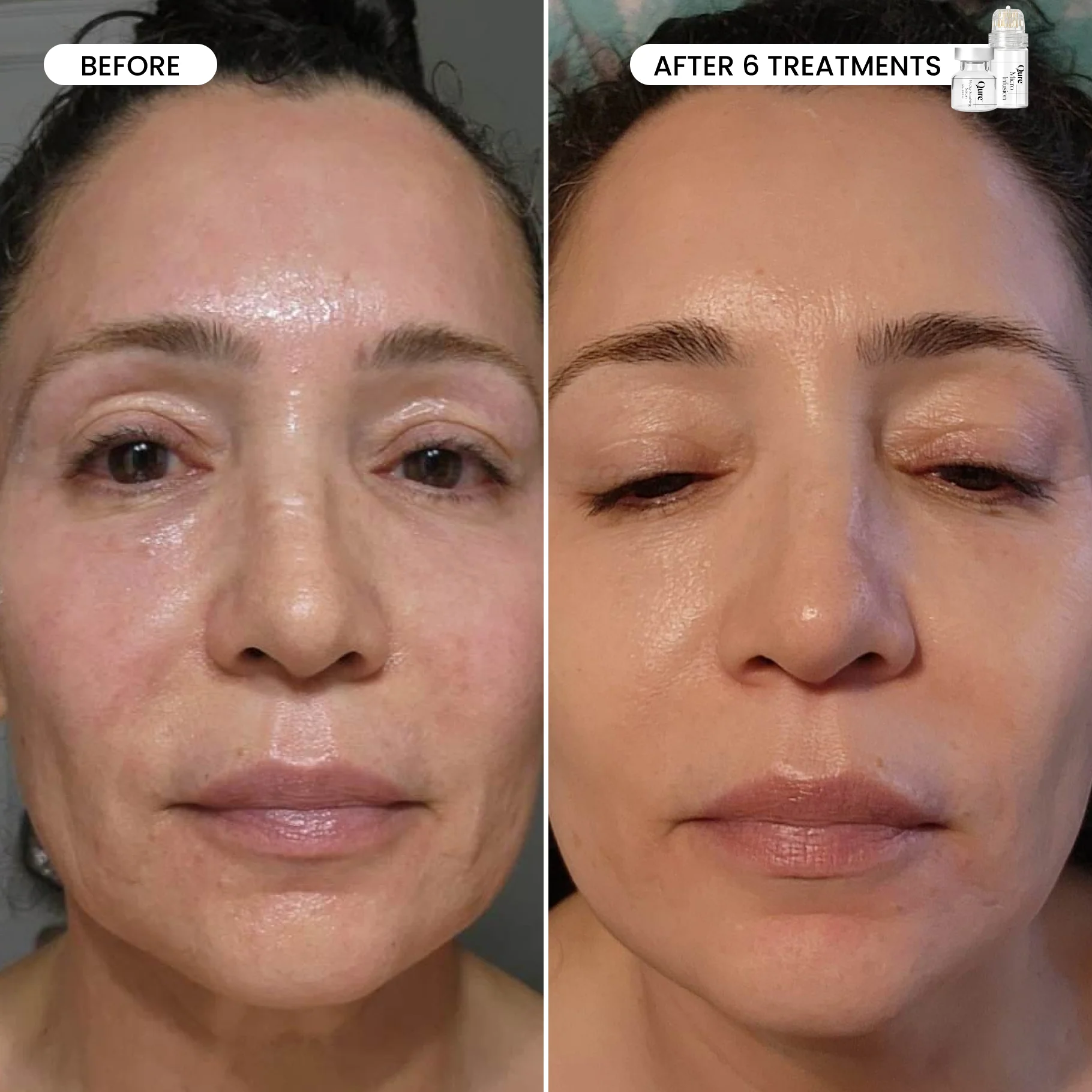 Micro-Infusion 3 Month Bundle (For Dark Spots) - Image 4