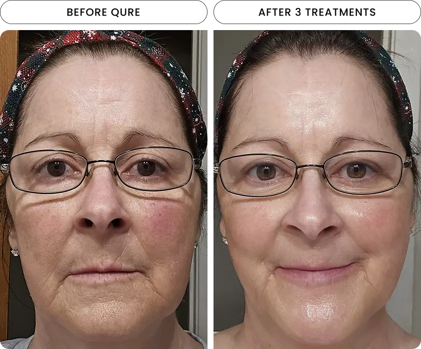 Micro-Infusion 6 Month Bundle (For Wrinkles) - Image 5